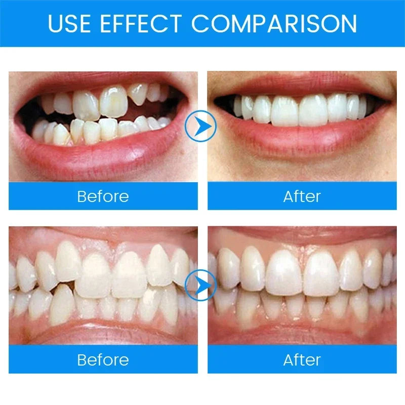 3-Stage Dental Orthodontic Mouth Guard